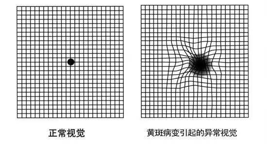 老年黃斑病變治療最有效最新方法,最新老年黃斑病變治療的有效方法