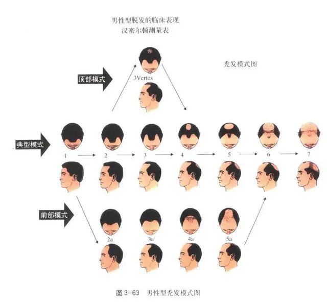 脫發(fā)研究最新進(jìn)展,脫發(fā)研究最新進(jìn)展，突破與未來展望